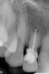 Figure 14 Case 2 radiograph taken after temporarily cementing the fractured clinical crown of tooth No. 7, slated for implant therapy.