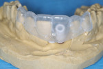 Figure 4 A temporary abutment is secured to the implant replica in the poured model, and the soft-tissue moulage is removed from the model. A prefabricated vacuum-formed template is then placed to demonstrate the indirect method of immediate provisionalization.