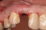 Figure 17 Healing abutment loosely fastened and transmucosal closure with resorbable sutures.