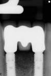 Figure 13 Radiograph obtained at approximately 19 months post-insertion of final restoration, demonstrating stable bone levels.