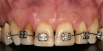 Figure 4  Three months after orthodontic treatment.