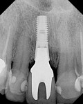 Figure 24 Example of bone maintenance: implant No. 8, patient J.M., loaded 24 months.
