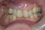Figure 18 Delivery of screw-retained provisional crown, placed out of occlusal contact on the day of surgery.