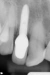 Figure 21 Radiographic evidence of bone maintenance 20 months after delivery of cement-retained crown.