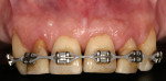 Figure 5  Seven months after orthodontic treatment. Note facial gingival margin levels between lateral incisors.
