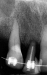 Figure 6  Radiographs after forced eruption. Note that the bone above the interproximal attachment levels of the centrals and cuspid teeth will eventually resorb.