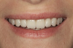 Figure 11 Full smile close-up, post-treatment.