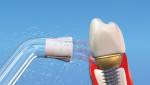 Figure 7 Specialized tip with three tufts of bristles used with an implant.