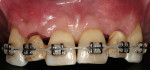 Figure 8  Intraoral view of the clinical crowns of the extracted lateral incisors attached to the orthodontic wire to avoid a removable prosthesis.