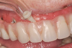 Figure 4 Water flosser being used to clean under a denture retained by implants using a subgingivally placed tip. (photo courtesy of Chris Salierno, DDS)