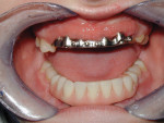 Figure 1 Bar attachment for full denture. Once the denture is seated it becomes difficult to clean under and around the implants. (photo courtesy of Marotta Dental Studio, www.marottadental.com)