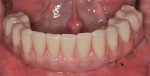 Figure 2 A hybrid prosthesis can also pose a maintenance problem with limited access under the denture and around the supporting implants. Arrow indicates ideal place for plaque proliferation and trapped debris. (photo courtesy of Chris
Salierno, DDS, www.broadhollow-dentistry.com)