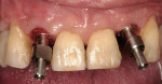 Figure 10  Custom impression copings on implants No. 7 and No. 10 for making final impression.