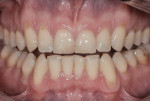 Figure 1 Close-up preoperative view demonstrating wear, improper inclination, and other esthetic issues.