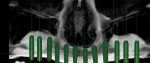 Figure 3   View of CBCT showing grafted bone and planning for implant placement.