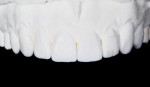 Figure 5 An enhanced design wax-up model was created to demonstrate improved tooth length and inclination.