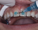 Figure 13 Following conservative tooth preparation, the facial surface of the teeth is etched, taking care to remain 0.5 mm away from the free gingival and interproximal margins.