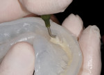 Figure 15 Reveal™ is placed into the matrix, with care taken to ensure complete and precise coverage of all tooth areas.