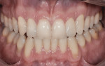 Figure 4 Photoshop applications were used to demonstrate how bleaching would change the appearance of the patient's smile.
