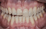 Figure 3 Digital smile design techniques were used to help the patient visualize proposed improvements.