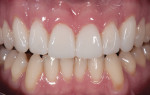 Figure 21 Close-up view of the patient's BFEP restorations.
