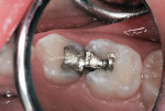 Figure 1 Fractured amalgams with caries at the margins.