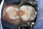 Figure 3 Deep penetration of caries infection revealed.