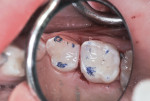 Figure 10 Articulating paper confirms occlusal contacts.