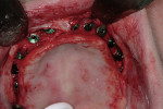 Figure 6  Implant cover screws prior to flap closure.