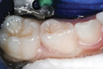 Figure 15 Primary first molar, preoperatively, with rubber dam in place.