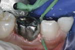 Figure 24 Knotted dental floss removes proximal cement.