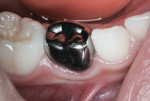Figure 25 One year post-cementation.