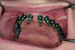 Figure 9  Open tray impression copings placed on the dental implants prior to impression.