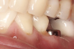 Figure 2 Occlusal view of disto-occlusal preparation.