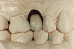 Figure 6 The pressed hybrid abutment crown was cut back for layering.