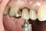 Figure 15 The hybrid abutment crown restoration was tightened into place.