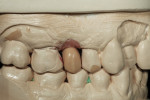 Figure 4 A full-contour wax-up of the hybrid abutment crown restoration was created that detailed the occlusal access hole.