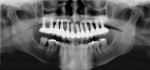 Figure 14  Panoramic view of final cemented bridge on 12 implants.