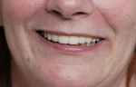 Figure 15  Posttreatment clinical view of patient’s smile showing good esthetics.