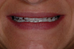 Figure 2  Close-up view shows low lip line and teeth that are aging faster than the patient is.