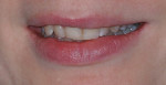 The patient’s concerns with her smile included tooth color, the uneven length of the maxillary central incisors, and the prominence of the upper left canine.
