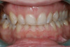 Fig 13. Dental views of the patient 3 years after surgical-orthodontic correction; right lateral view (Fig 13), frontal view (Fig 14), and left lateral view (Fig 15).