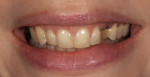 A composite mock-up was done to evaluate the final tooth length and shape and the patient’s function.