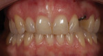 After implant placement and orthodontic
treatment, the teeth were in good position for conservative porcelain veneer restorations.