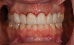 The provisional restorations in place showing the gingival symmetry after crown lengthening on teeth Nos. 7 through 9. Note the darkness in the gingival area of tooth No. 11.