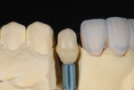 The margin placement of the custom abutment was located 0.5-mm apical to the free gingival margin, allowing proper emergence and ease of cement cleanup.