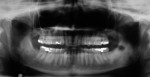 Figure 3  Preoperative panoramic radiograph shows minimal bone loss and recurrent decay beneath some of the existing restorations.