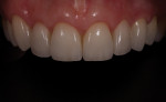 The final restorations showing the healing of the tissue around the crown-lengthened teeth Nos. 7 through 9.