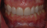 Photograph taken 2 months after insertion shows gingival maturation
around teeth nos. 7 through 9 and harmonious gingival color at the No. 11 position.