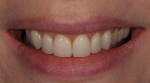 The definitive restorations blend harmoniously with the patient’s natural dentition.
